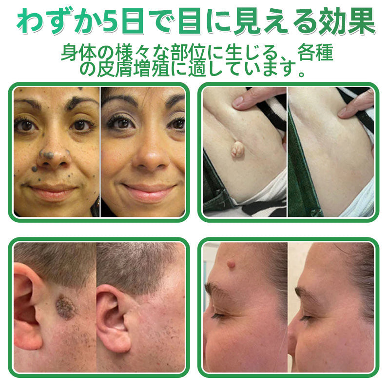 𝐇𝐮𝐝𝐫𝐨𝐬® 📌 𝟐-𝐢𝐧-𝟏 ハイドロコロイドマイクロニードルパッチ｜盛り上がったほくろ、ニキビ、平らなイボおよび皮膚の突起の除去用に特別設計｜𝟏𝟒𝟒枚入りパッケージ🌱🌱