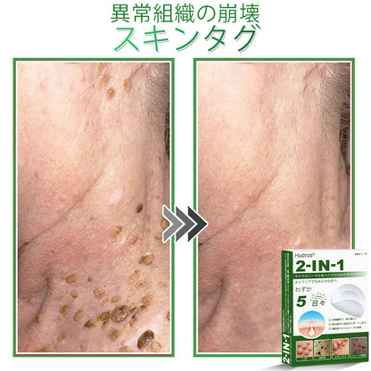 𝐇𝐮𝐝𝐫𝐨𝐬® 📌 𝟐-𝐢𝐧-𝟏 ハイドロコロイドマイクロニードルパッチ｜盛り上がったほくろ、ニキビ、平らなイボおよび皮膚の突起の除去用に特別設計｜𝟏𝟒𝟒枚入りパッケージ🌱🌱