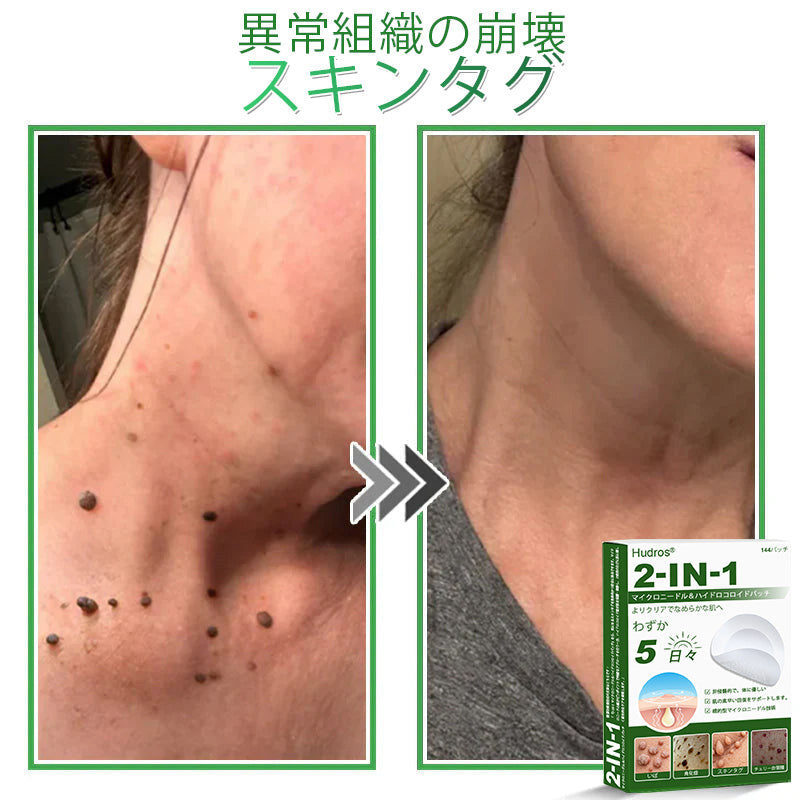 𝐇𝐮𝐝𝐫𝐨𝐬® 📌 𝟐-𝐢𝐧-𝟏 ハイドロコロイドマイクロニードルパッチ｜盛り上がったほくろ、ニキビ、平らなイボおよび皮膚の突起の除去用に特別設計｜𝟏𝟒𝟒枚入りパッケージ🌱🌱