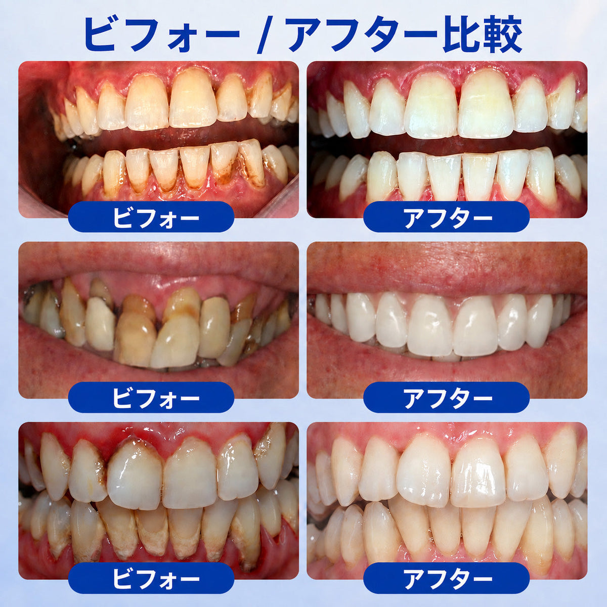 🇯🇵 👨‍⚕️✅🦷 HEATWOLF® GumRevive – 歯周組織修復ジェル 🦷✨2️⃣